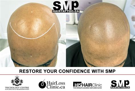 scalp micropigmentation wimbledon|Scalp Micropigmentation: Cost, Benefits & More.